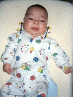 Lisa Parramore's son Adam as a baby with jaw pins